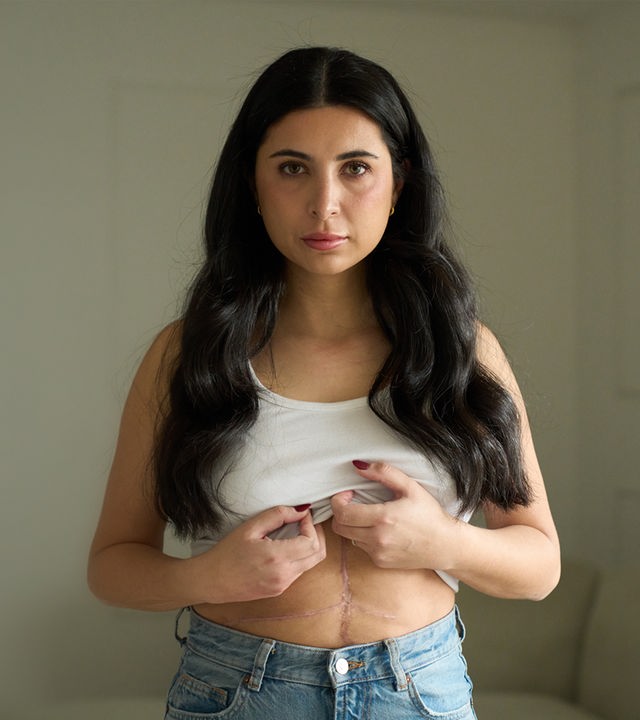 Sarah trägt ein weißes Trägertop, welches sie mit beiden Händen hochhält. Man sieht eine große Narbe über ihren Bauch. Sie schaut in die Kamera. 