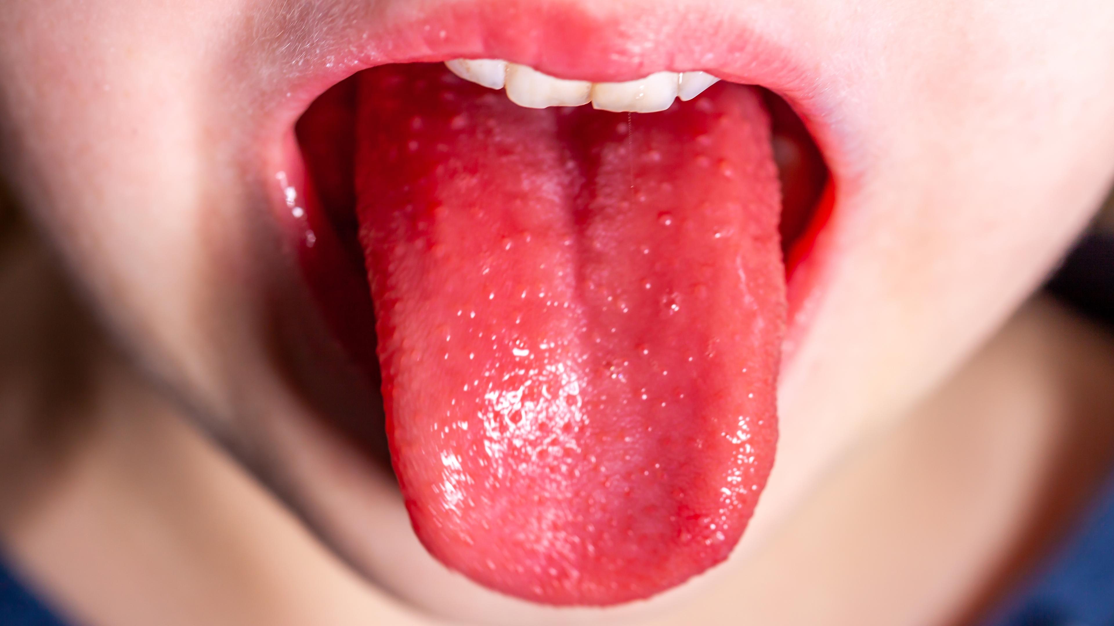 Ein Kind mit Scharlach streckt seine gerötete Zunge raus.