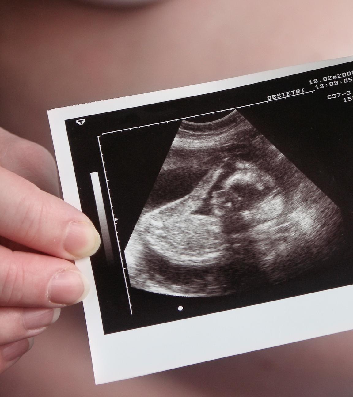 Im Hintergrund sieht man einen Schwangerschaftsbauch, welcher durch ein Ultraschallbild verdeckt wird.