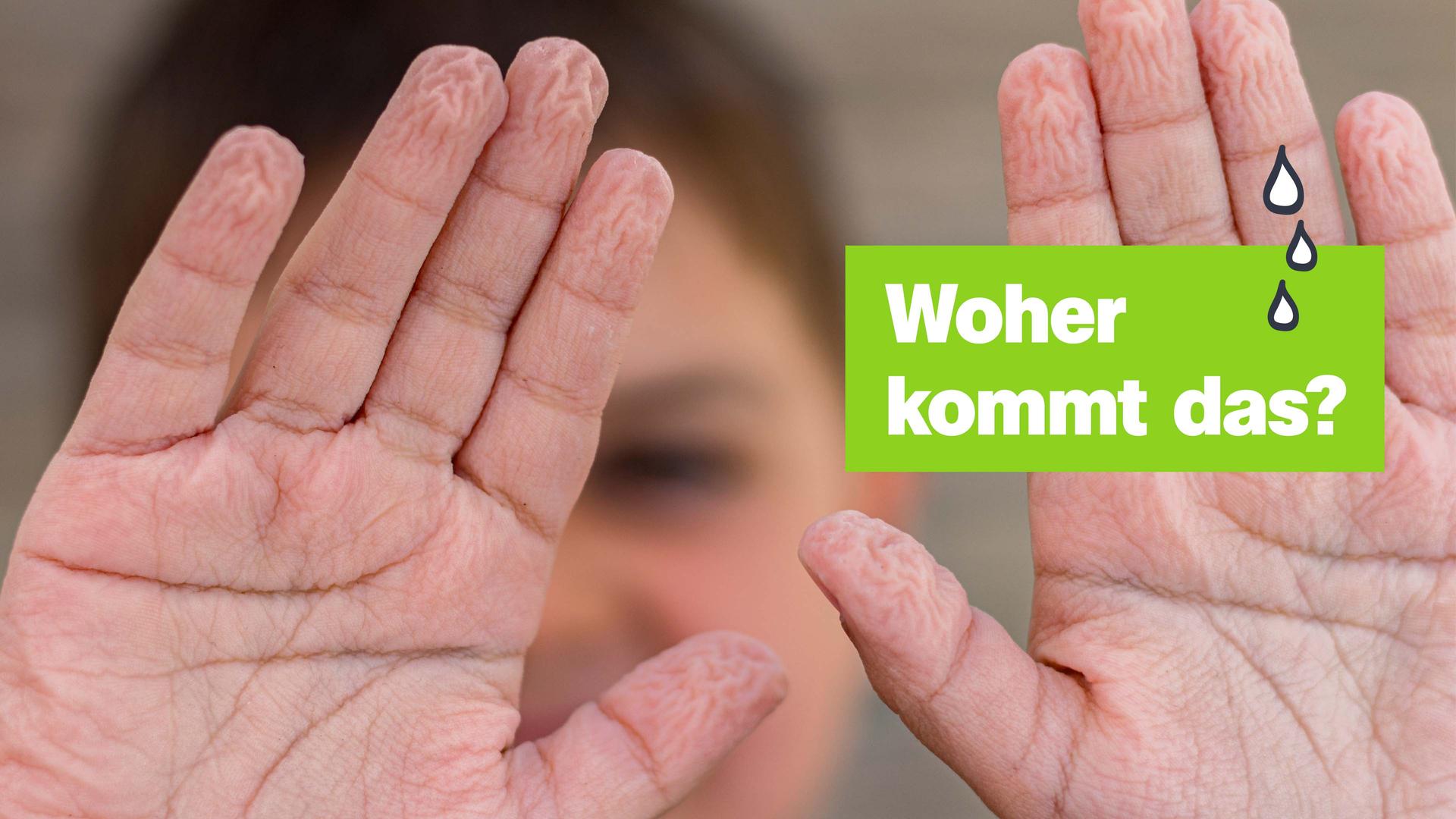 Eine Person hält ihre durch den langen Kontakt mit Wasser schrumpeligen Handflächen in die Kamera. Rechts mittig der Text "Woher kommt das?"