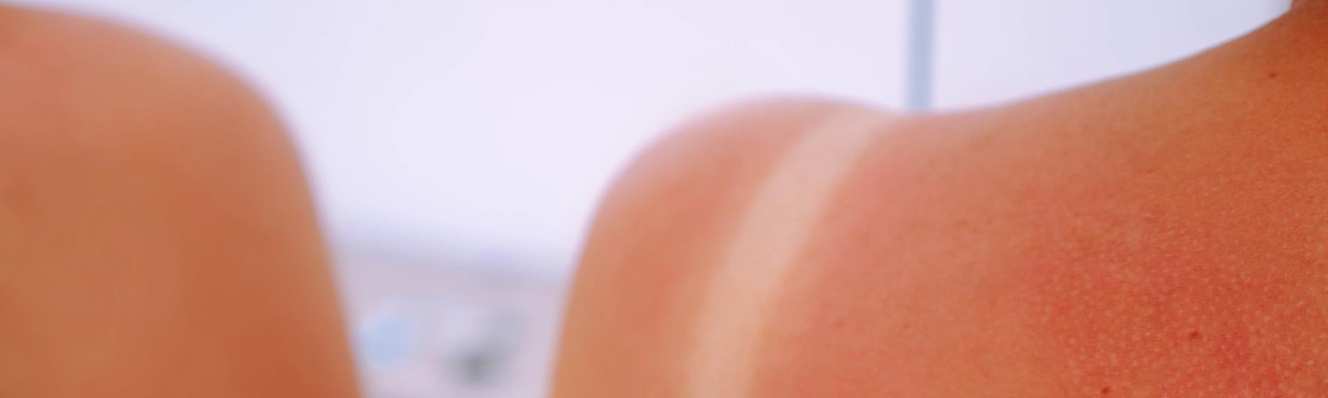 Symbolbild: Frau mit Sonnenbrand an der Schulter