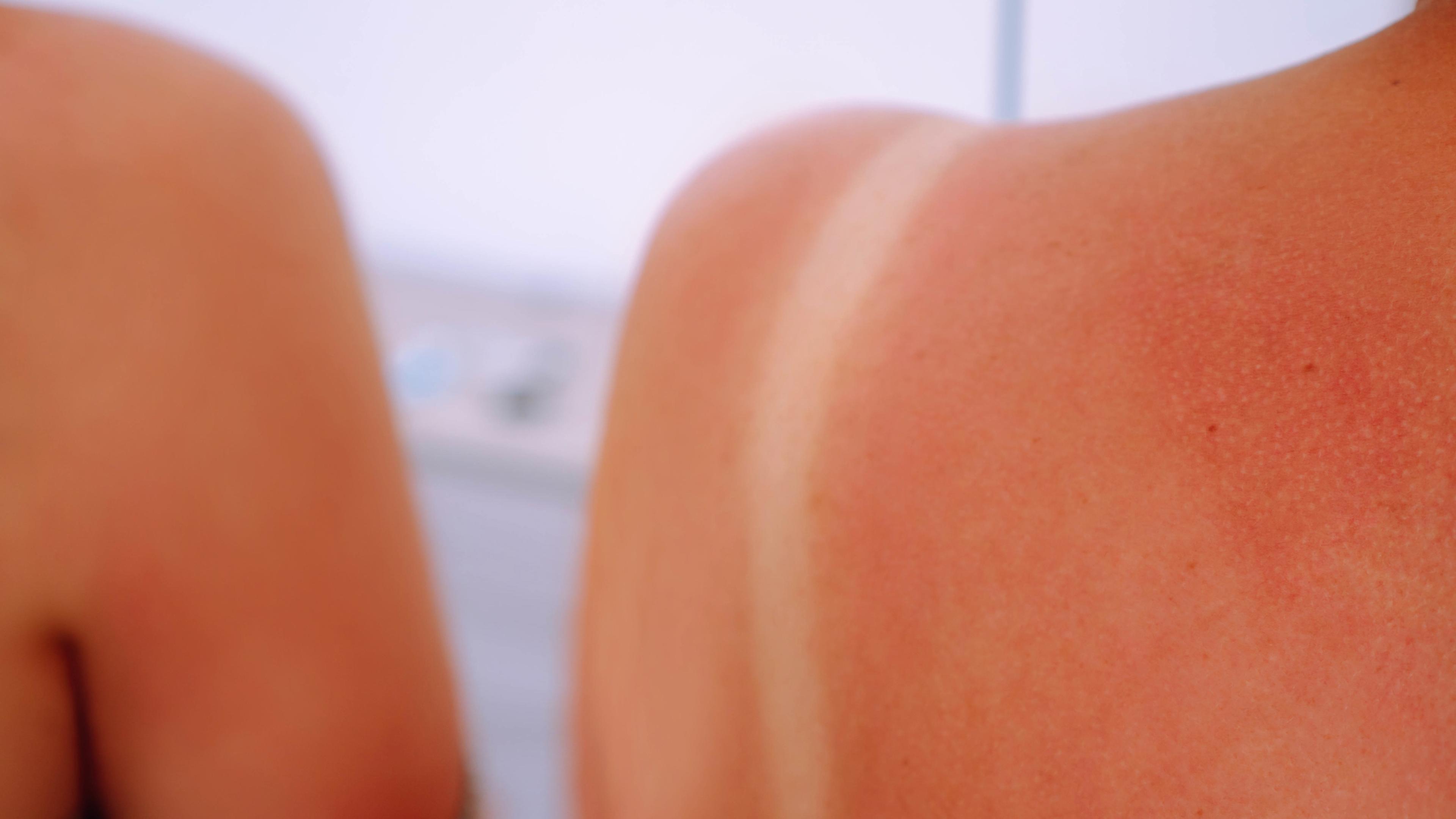 Symbolbild: Frau mit Sonnenbrand an der Schulter