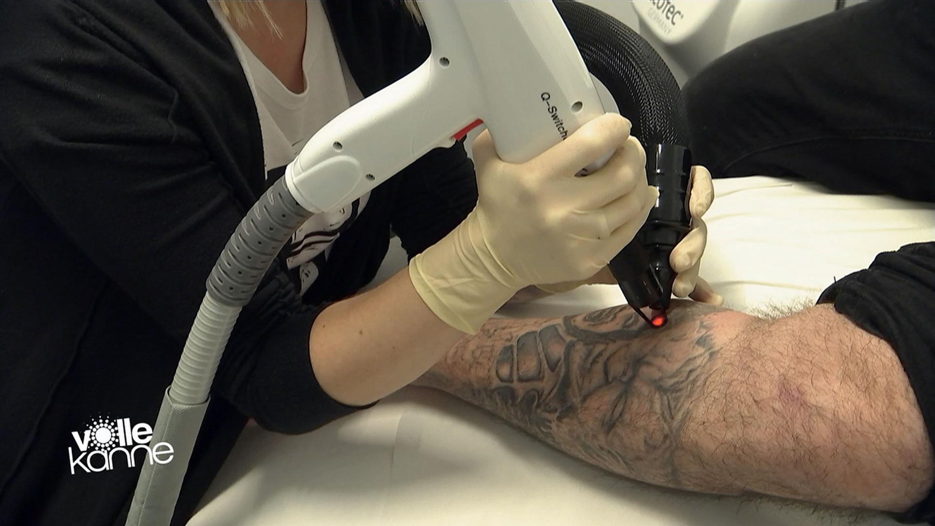 Tattoo Entfernung Per Laser Zdfmediathek