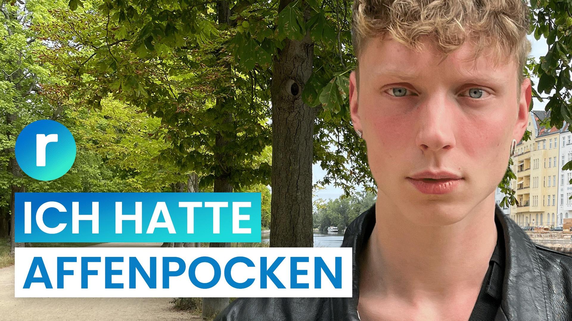 Affenpocken: So lief es bei mir ab - reporter