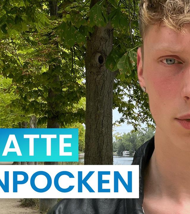 Affenpocken: So lief es bei mir ab - reporter