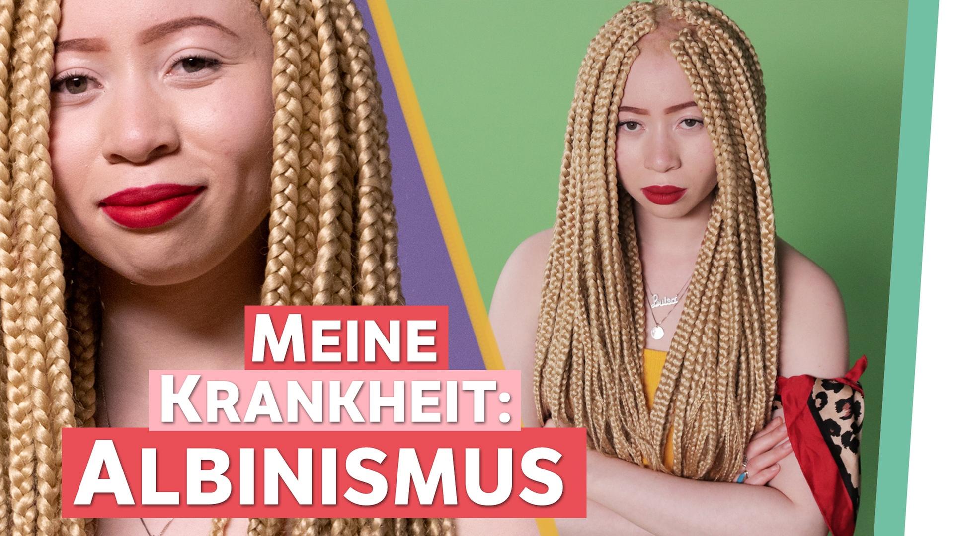 Albinismus – Ich bin eine Schwarze Frau mit Weißer Haut. - Auf Klo