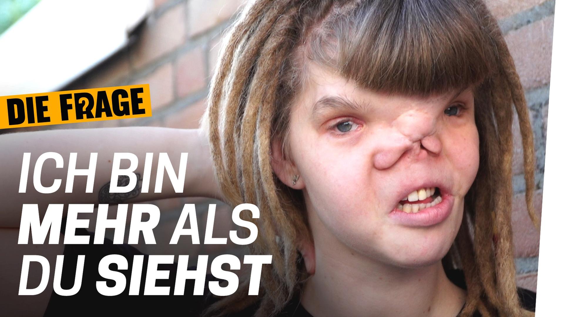 Body Positivity: Meine Narben gehören zu mir - Wie lebe ich mit einer schweren Krankheit? Folge 4