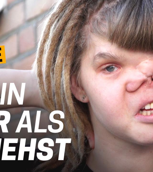 Body Positivity: Meine Narben gehören zu mir - Wie lebe ich mit einer schweren Krankheit? Folge 4