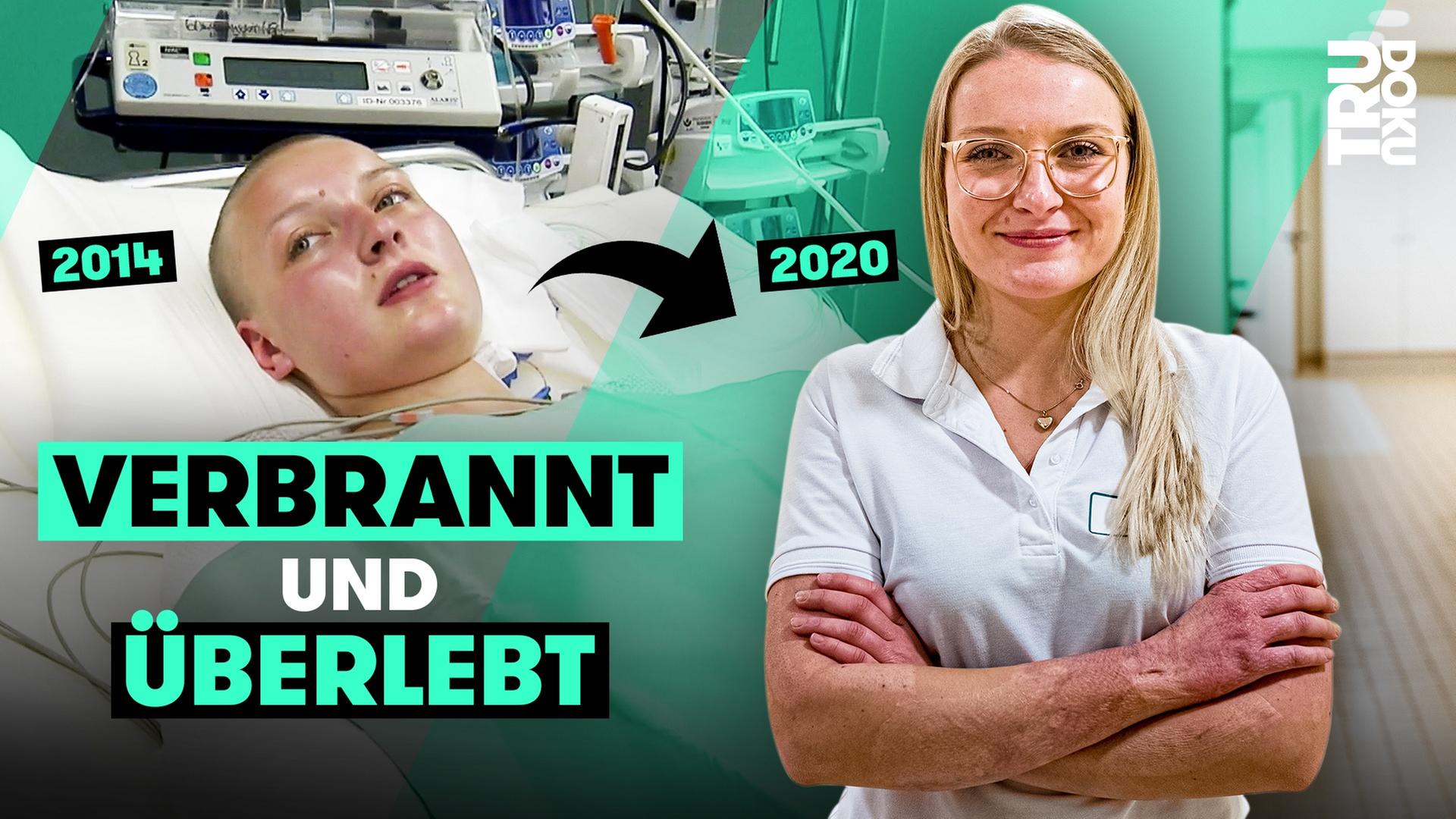 “Die Narben gehören zu mir!”: Annika überlebt einen schweren Brandunfall I TRU DOKU