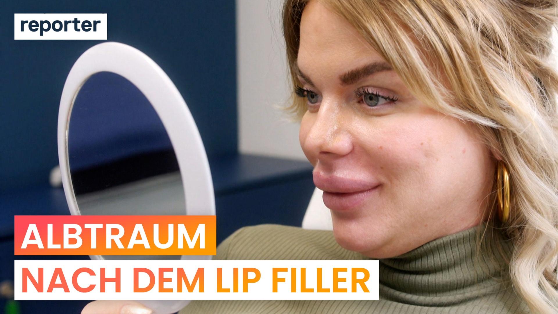 Hyaluron auflösen: Sie will ihren Lip-Filler-Fail loswerden - reporter