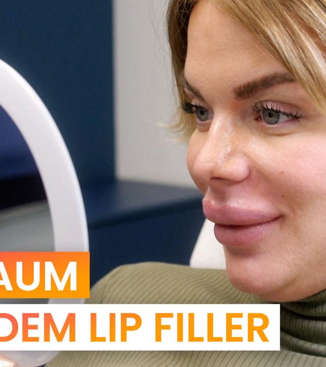 Hyaluron auflösen: Sie will ihren Lip-Filler-Fail loswerden - reporter