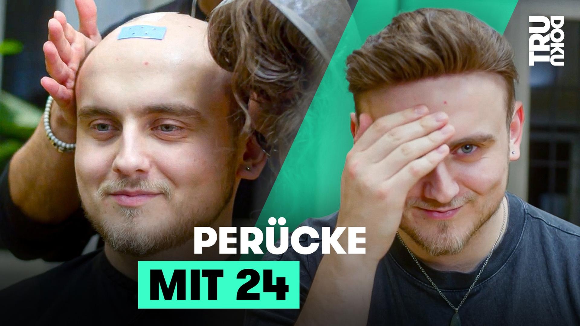 Kahler Kopf: Dennis fand sich hässlich - TRU DOKU