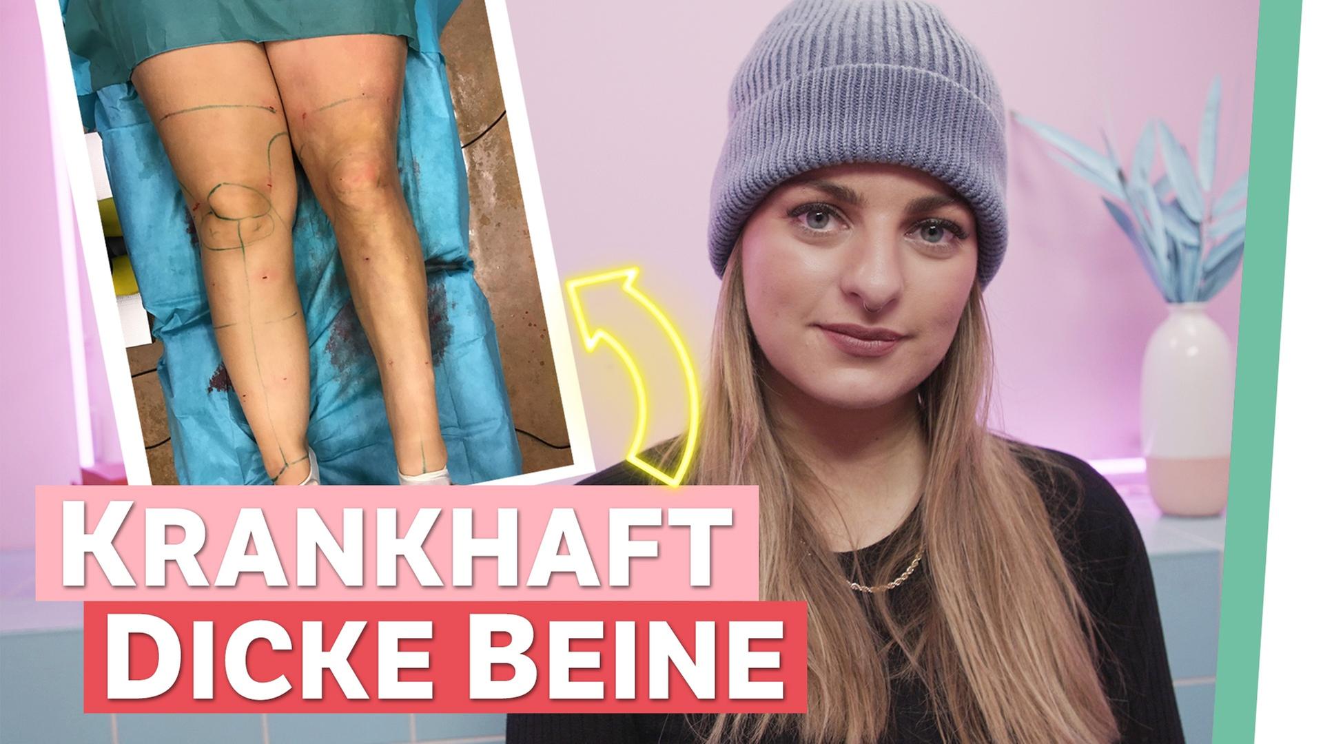 Lipödem: Fettabsaugung gegen Schmerzen - Auf Klo