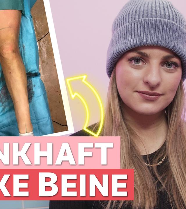 Lipödem: Fettabsaugung gegen Schmerzen - Auf Klo