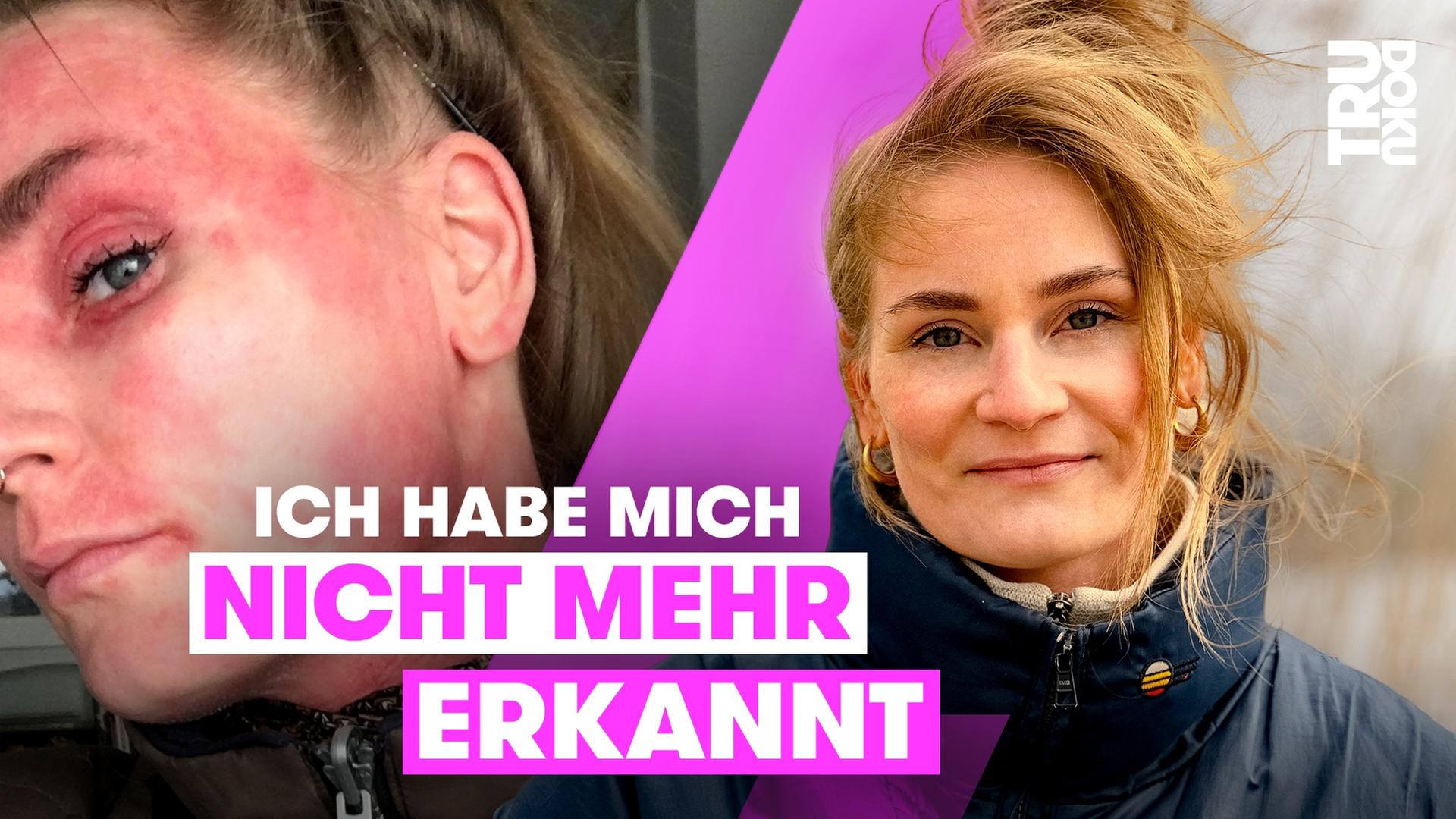 Neurodermitis-Hölle: Nora kann heute wieder in den Spiegel schauen I TRU DOKU