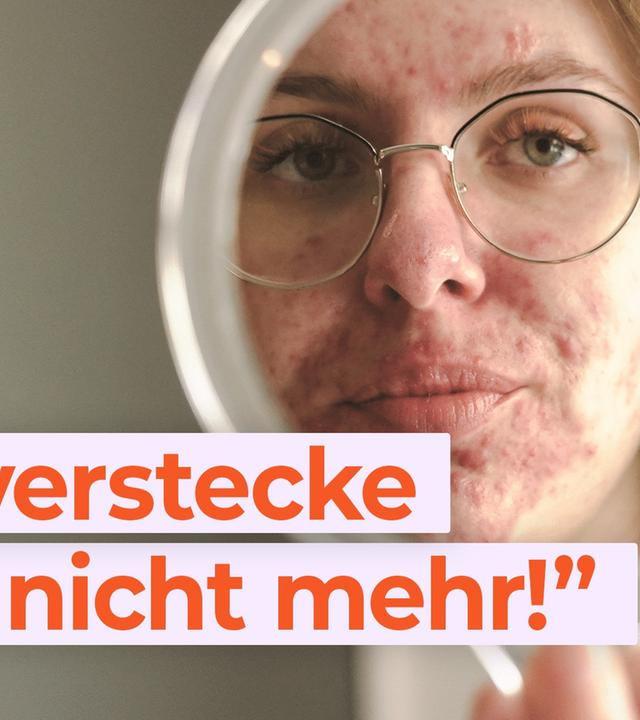Schluss mit Pickel-Scham: Akne gehört zu mir