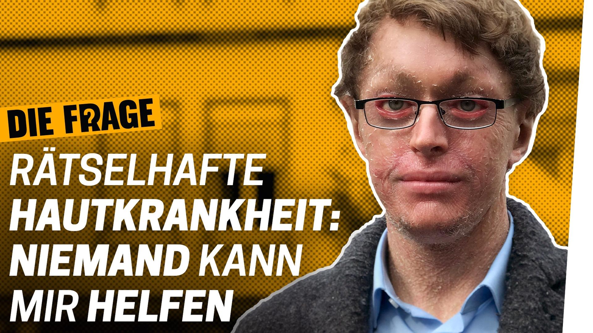 Seltene Krankheit: Mein Leben ohne Heilung - Wie lebe ich mit einer schweren Krankheit? Folge 7