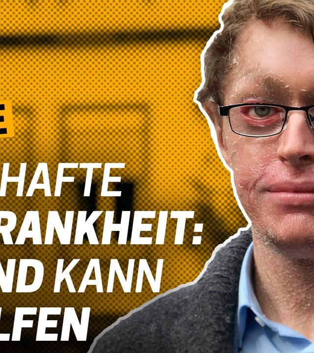 Seltene Krankheit: Mein Leben ohne Heilung - Wie lebe ich mit einer schweren Krankheit? Folge 7
