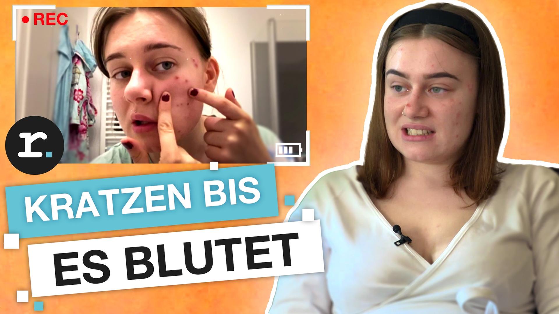 Skin Picking: Ab wann ist Pickel ausdrücken eine Krankheit? I reporter