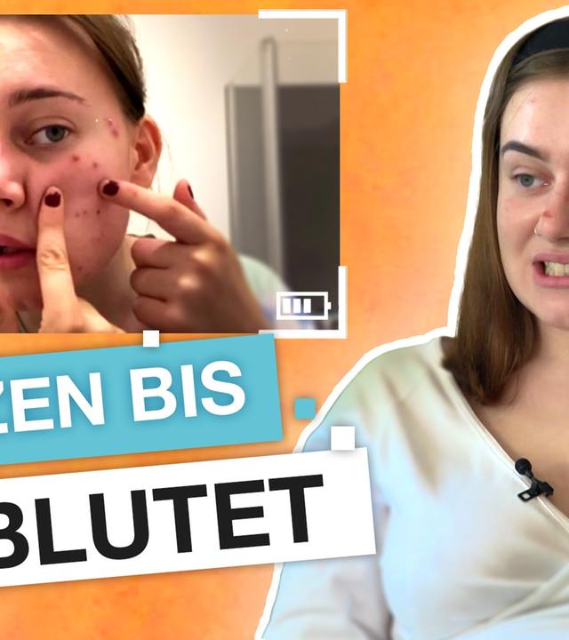 Skin Picking: Ab wann ist Pickel ausdrücken eine Krankheit? I reporter