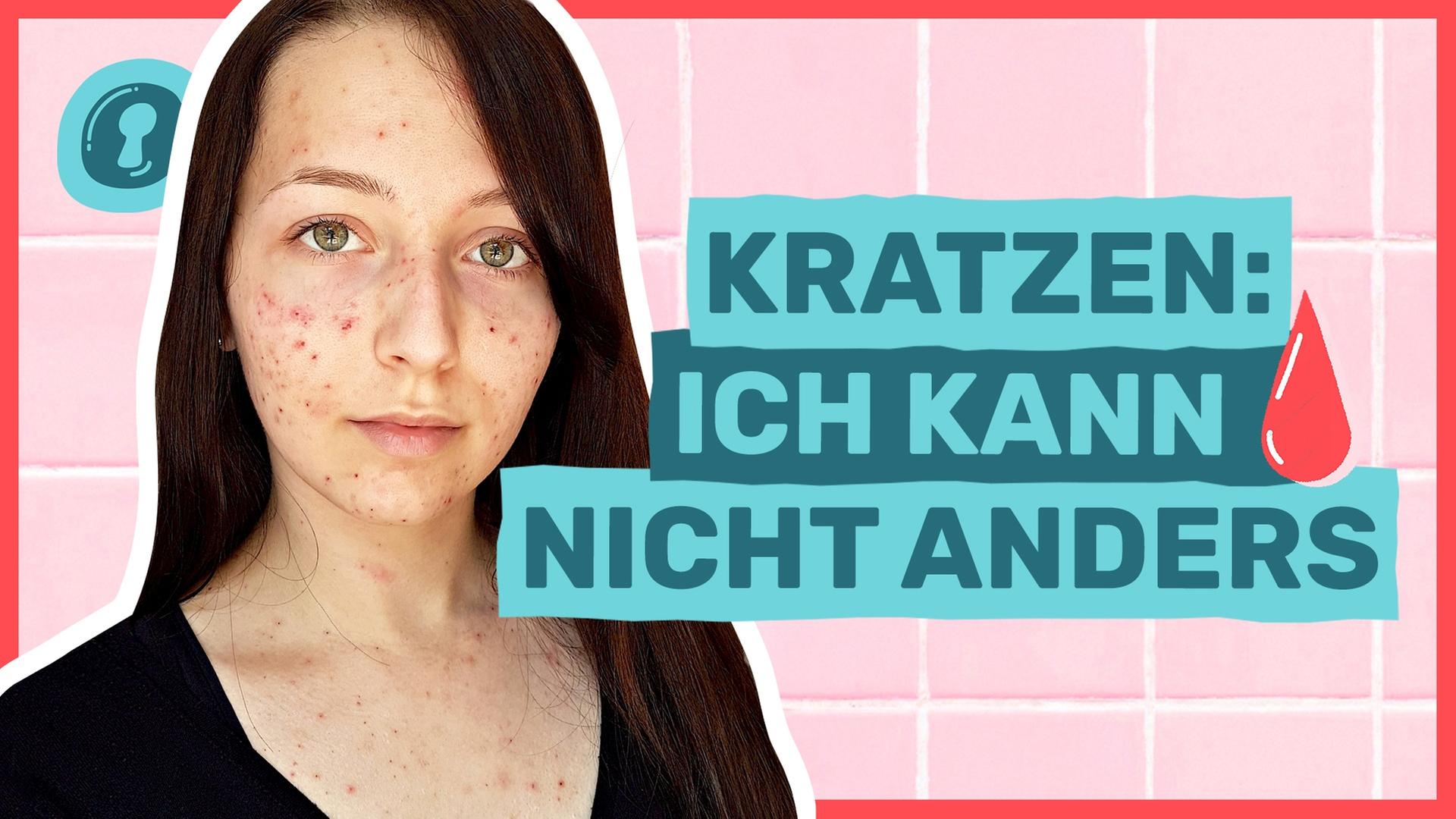 Skinpicking: Krankhaft Pickel ausdrücken - Auf Klo