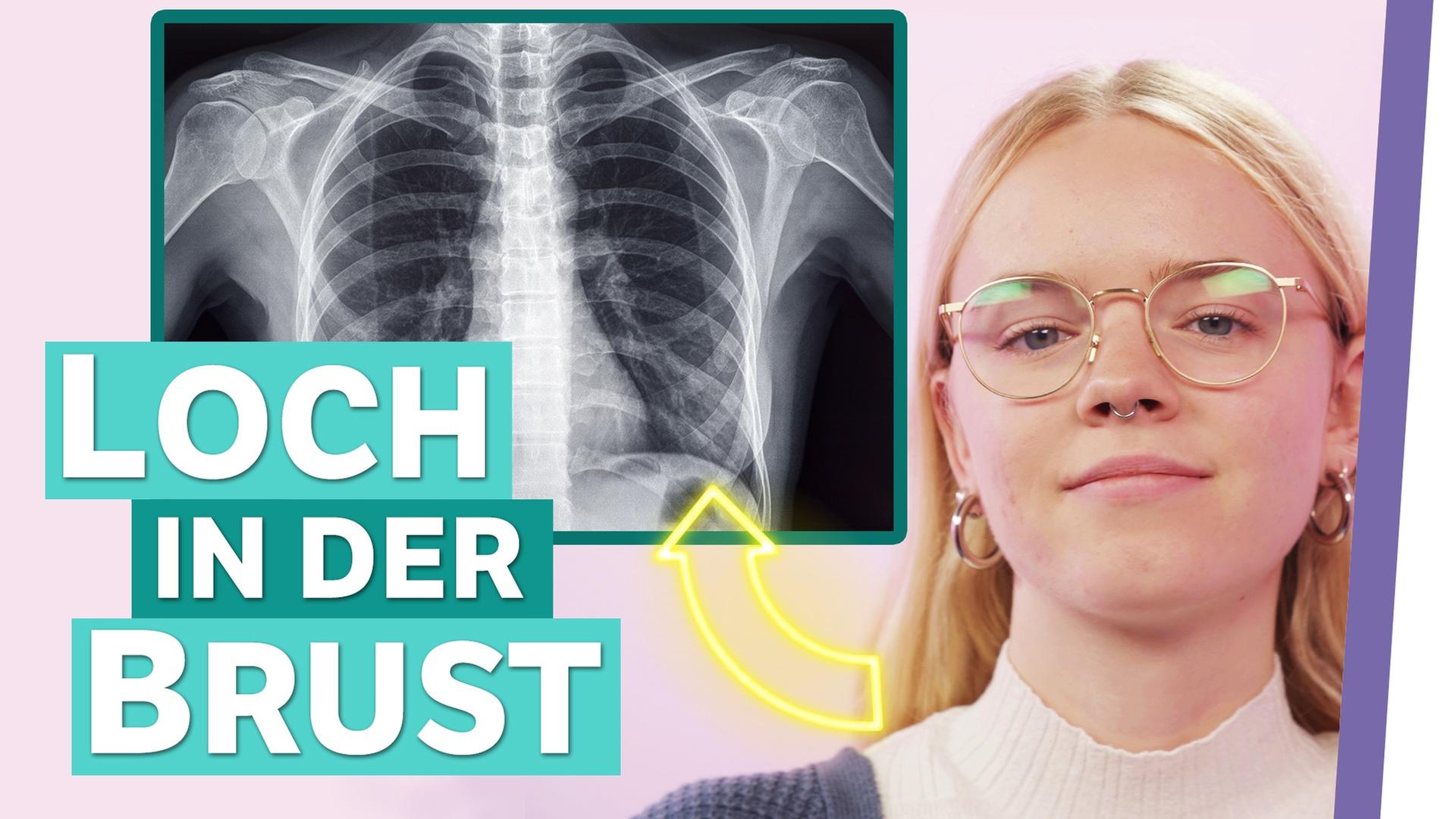 Trichterbrust: Meine Brust wuchs nach innen - Auf Klo