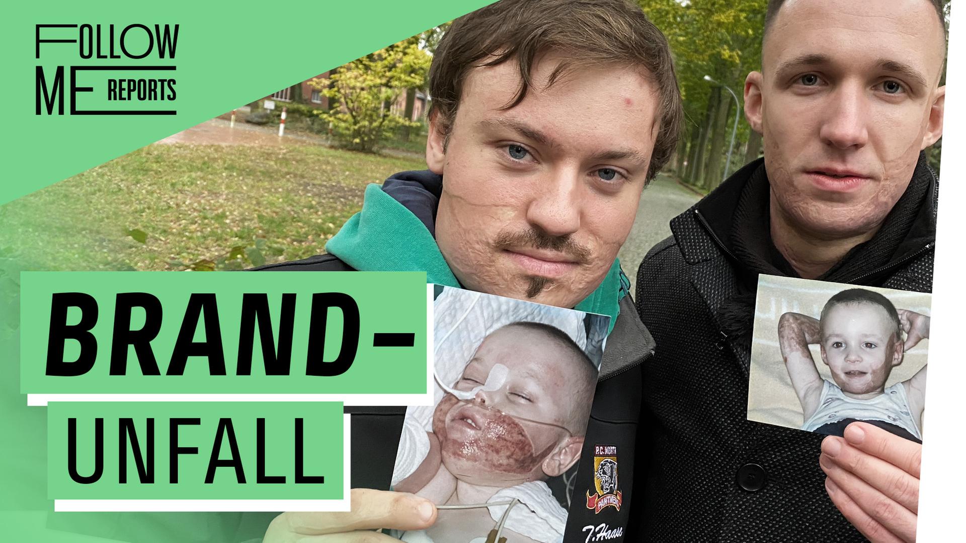 Unfall mit 3 Jahren – Wir sind verbrannt