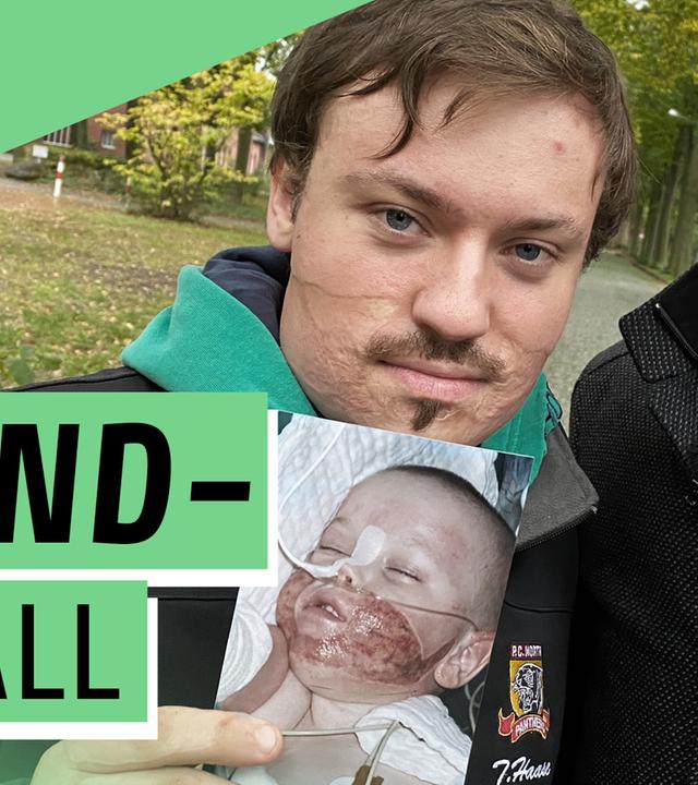 Unfall mit 3 Jahren – Wir sind verbrannt