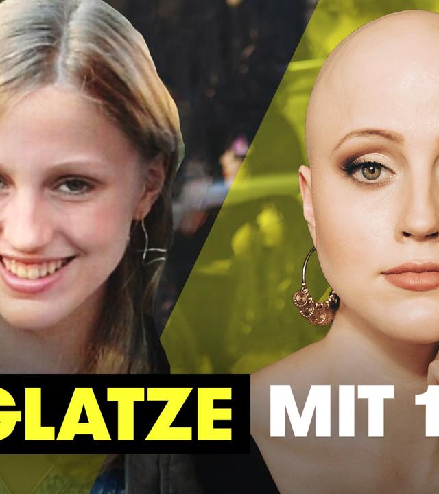 Wenn dir alle Haare ausfallen – Julies Leben mit Alopecia I TRU DOKU