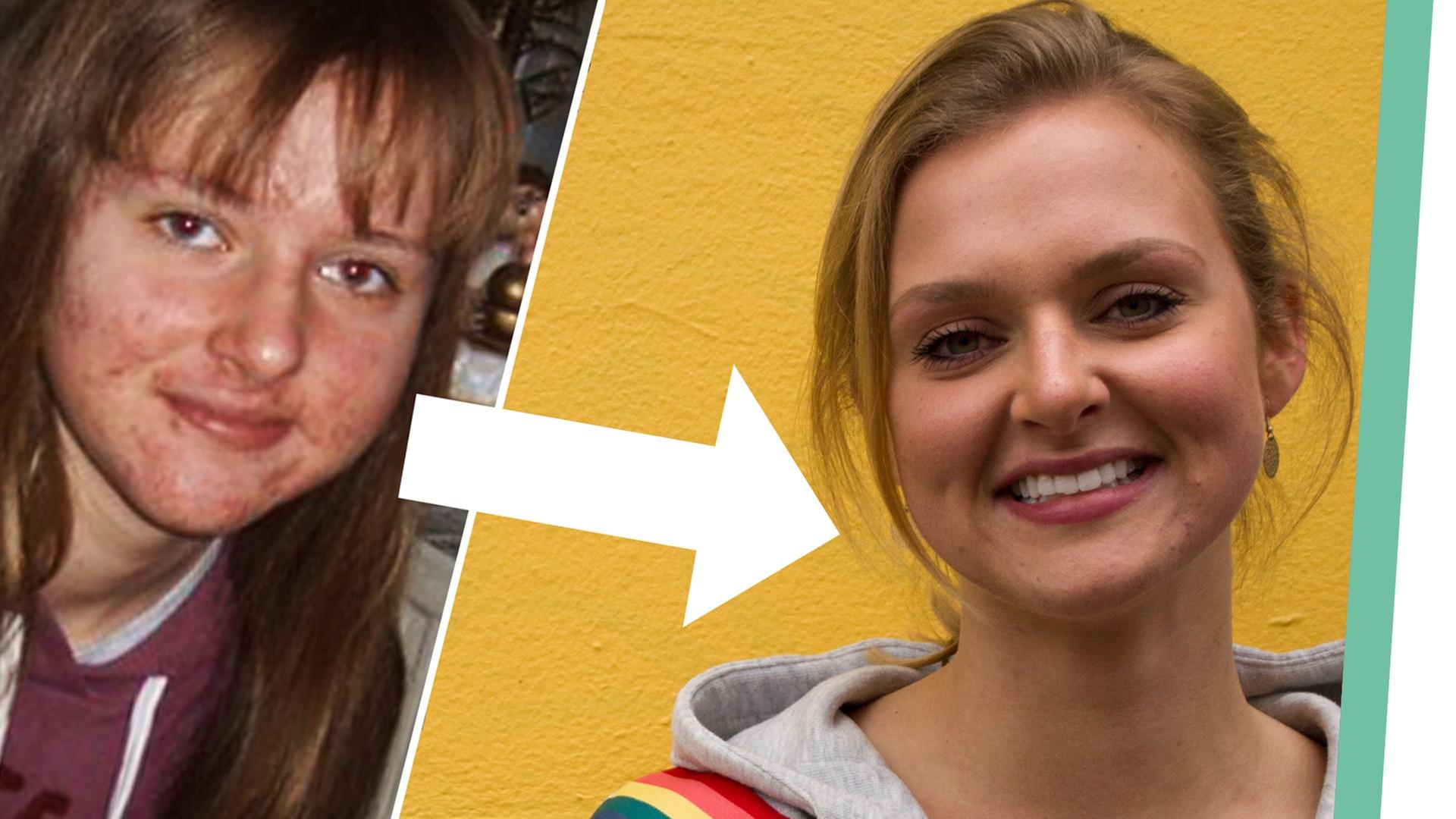 Wie du PICKEL & AKNE loswirst + 4 Schminktipps (Emoji?)