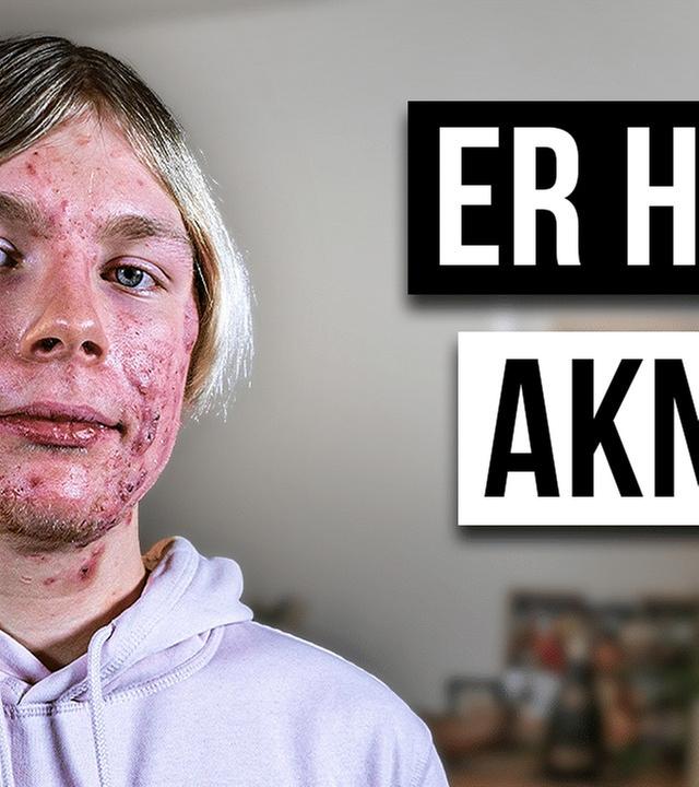Wie ist das AKNE ZU HABEN?