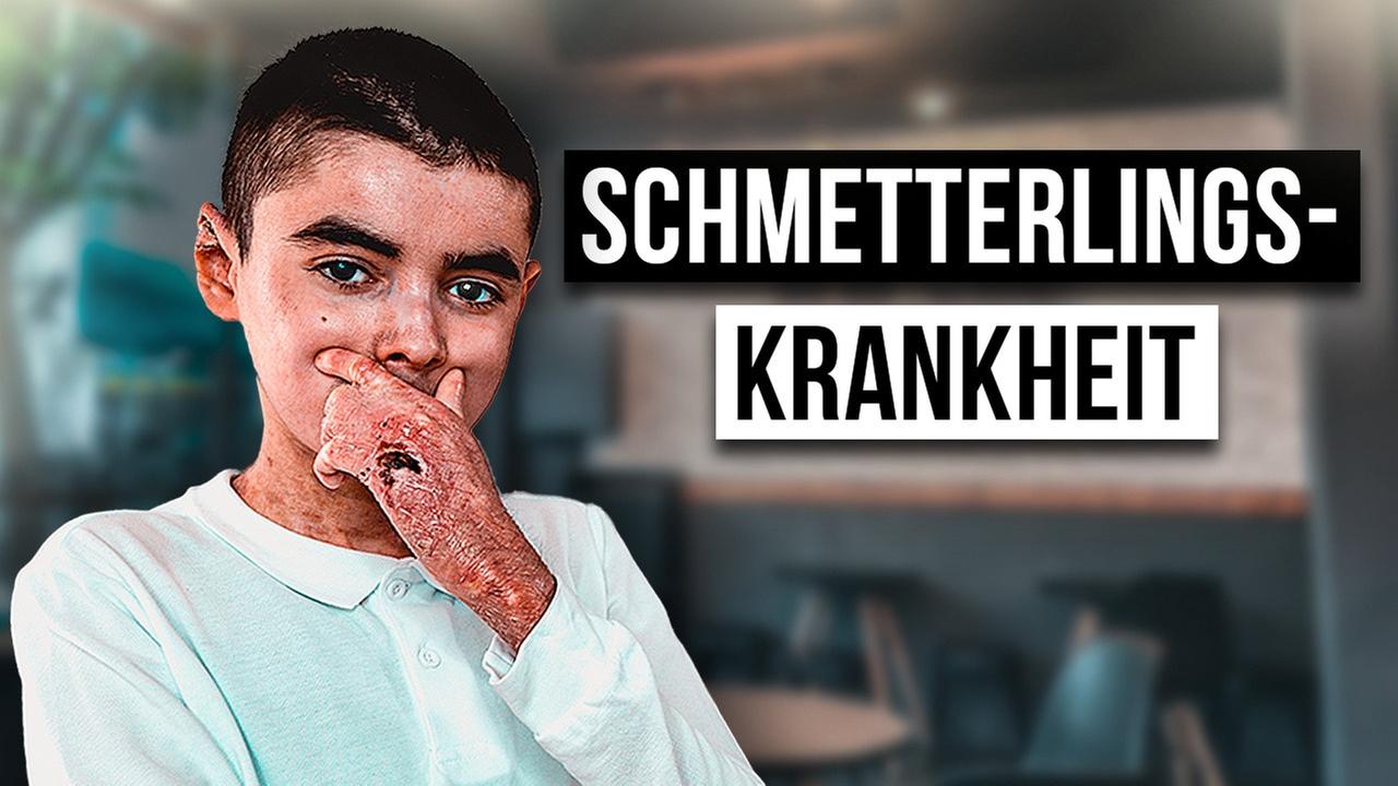 Wie ist das DIE SCHMETTERLINGSKRANKHEIT ZU HABEN?