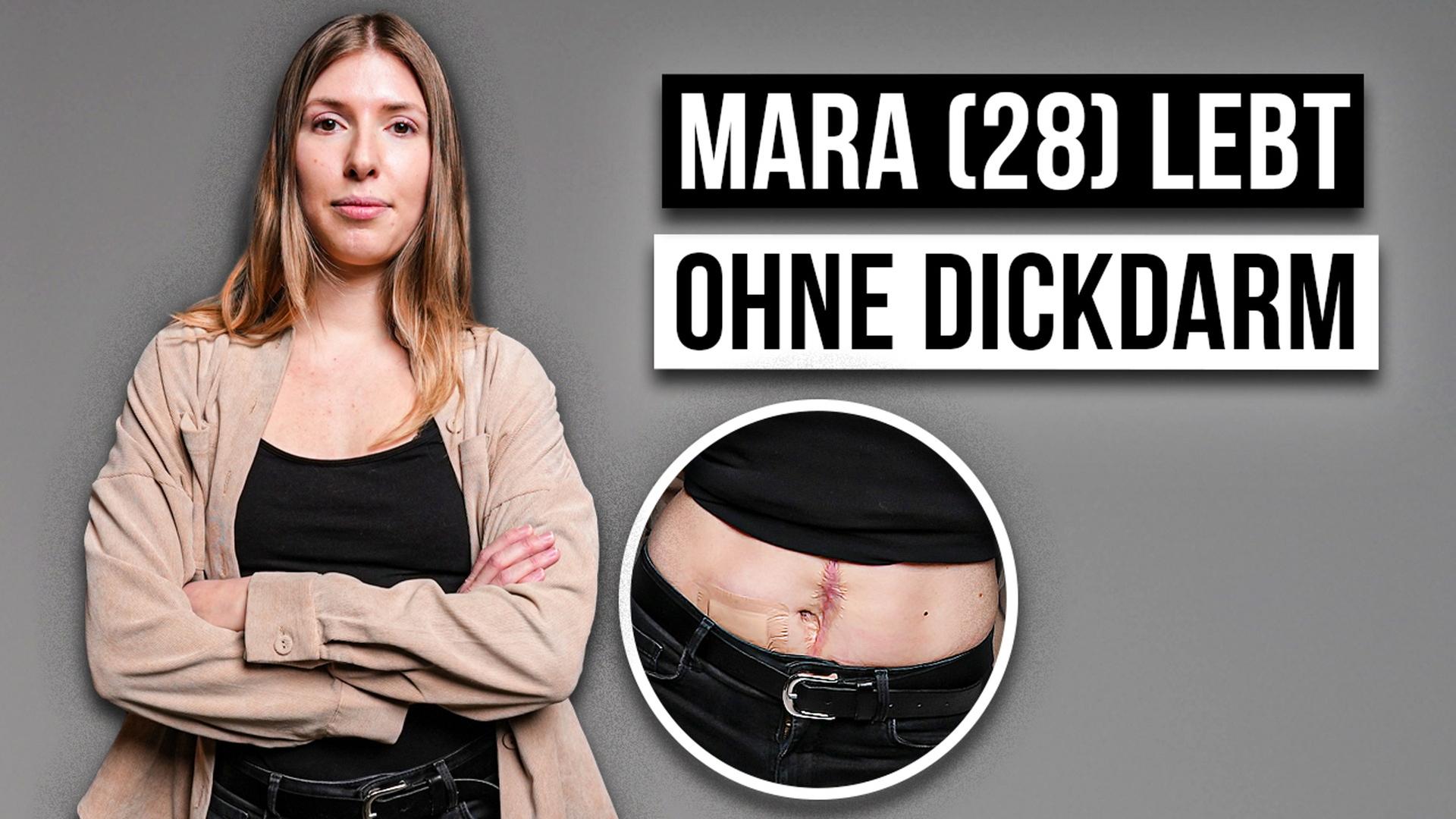 Wie ist das keinen DICKDARM ZU HABEN?