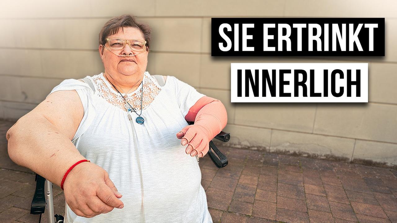 Wie ist das LIPÖDEM ZU HABEN?