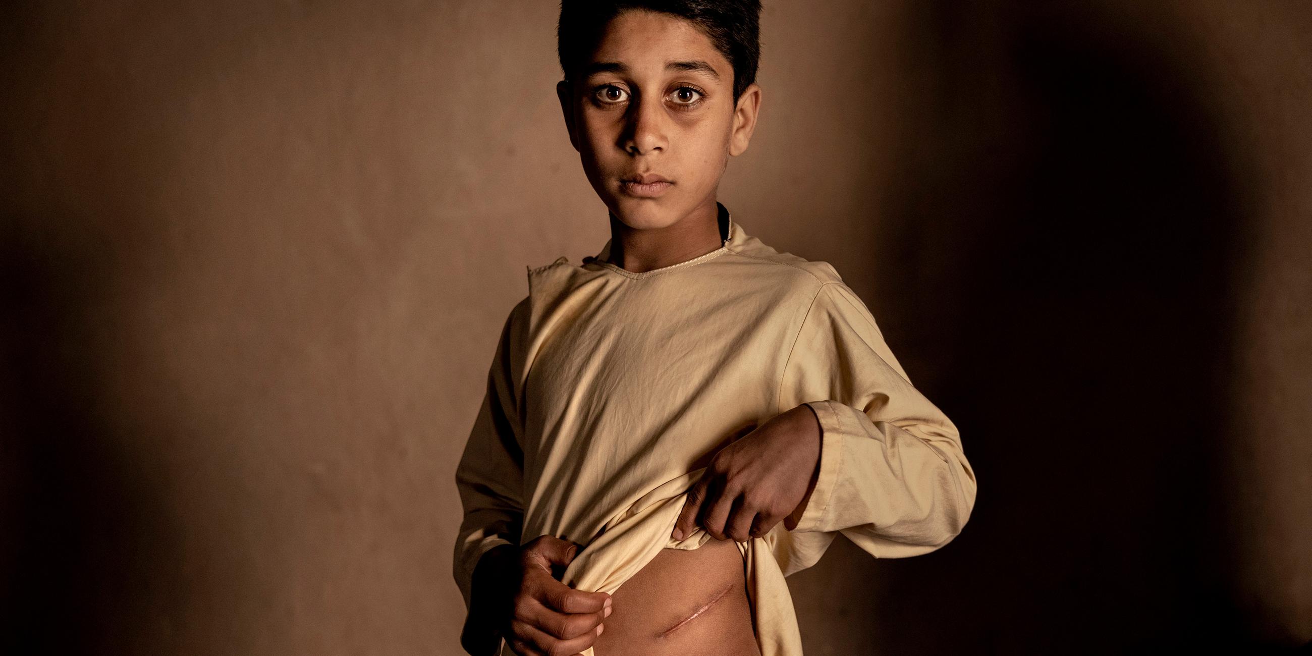 Unicef-Fotos des Jahres: Junge mit Narbe. Der 15-jährige Khalil Ahmad aus Afghanistan