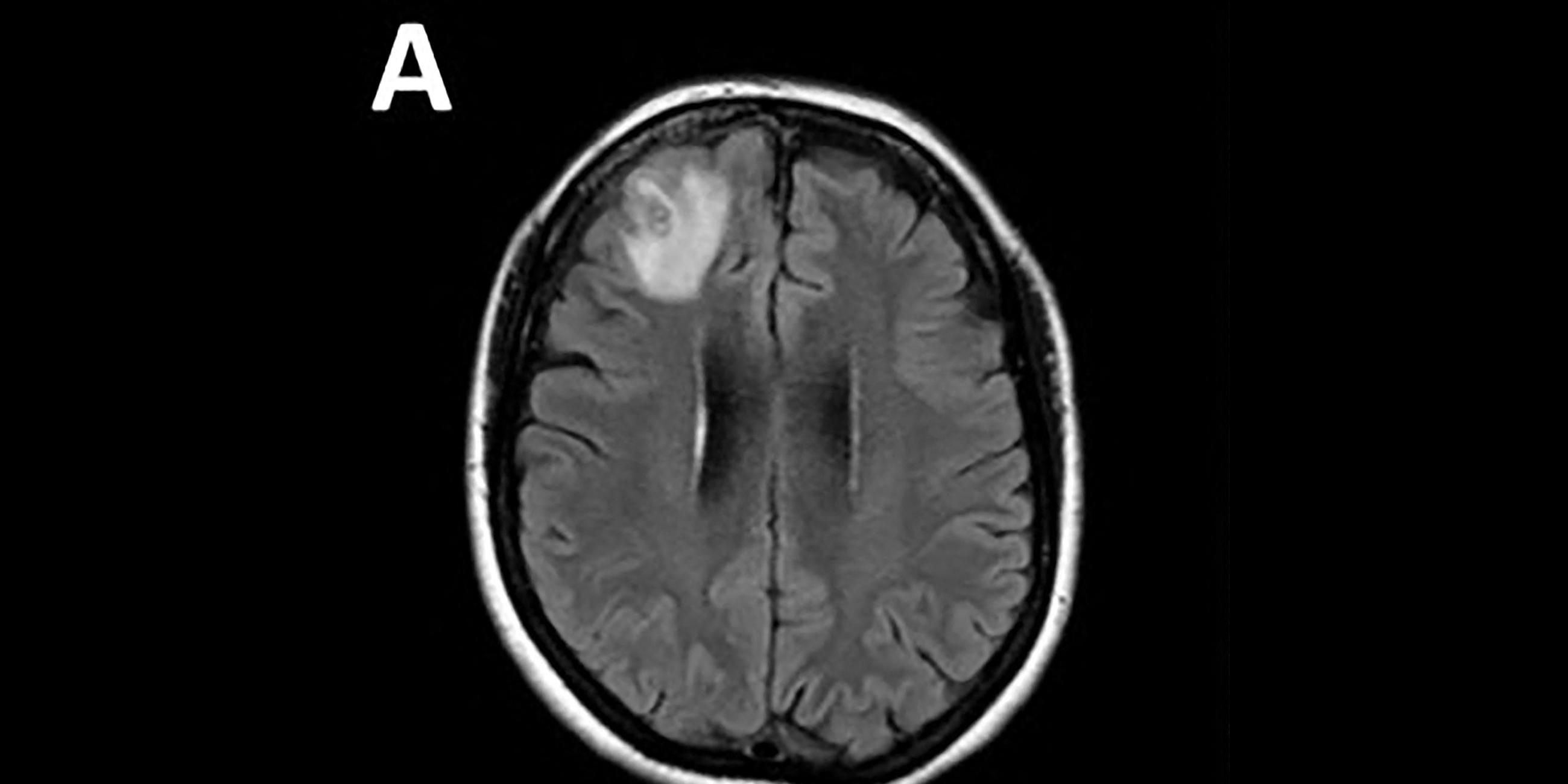 Gehirnscan von eine Frau mit parasitärer Wurm, aufgenommen am 29.08.2023 Canberra (Australien)