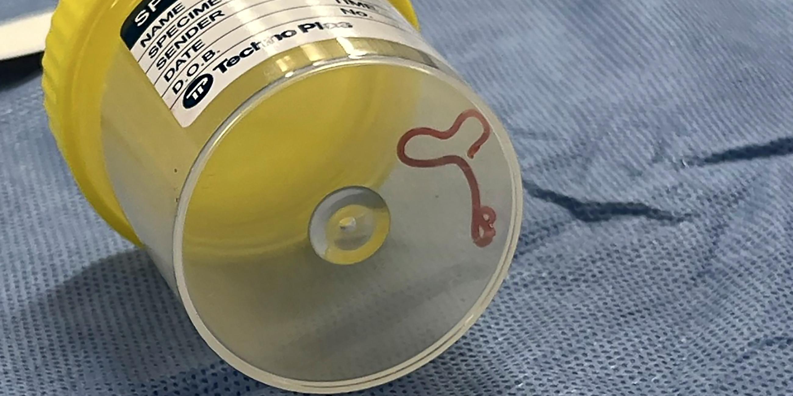 Ein Wurm-Parasiten in einem Probengefäß in einem Krankenhaus in Canberra, Australien, aufgenommen am 29.08.2023