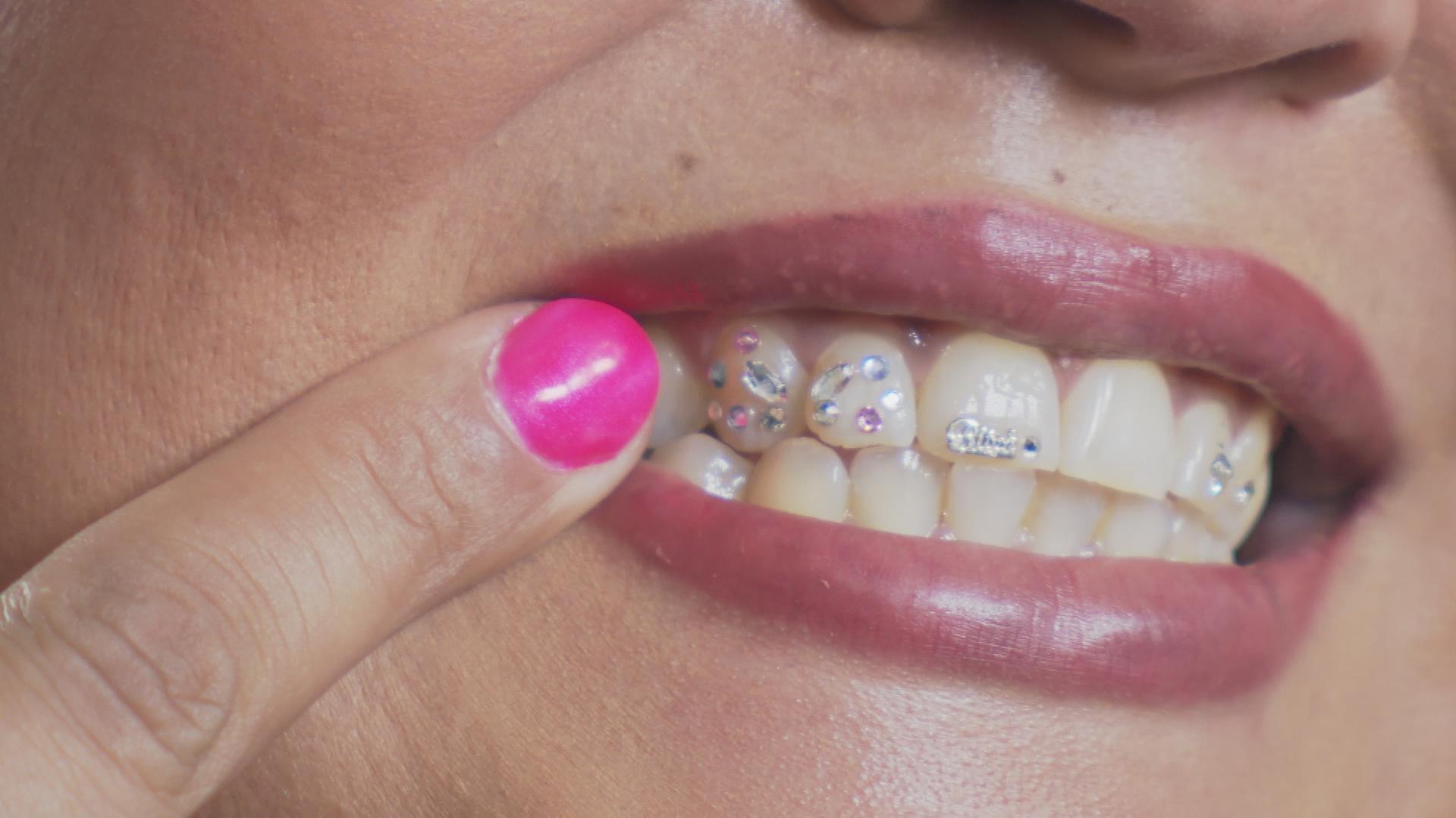 Zahnschmuck aus London