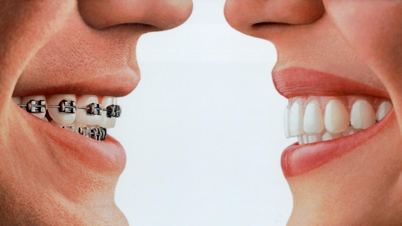 Wie lange muss man nach der festen Zahnspange eine lose tragen?